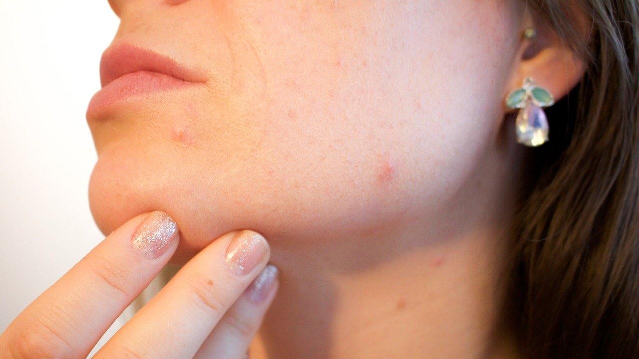 Acne giovanile, i rimedi