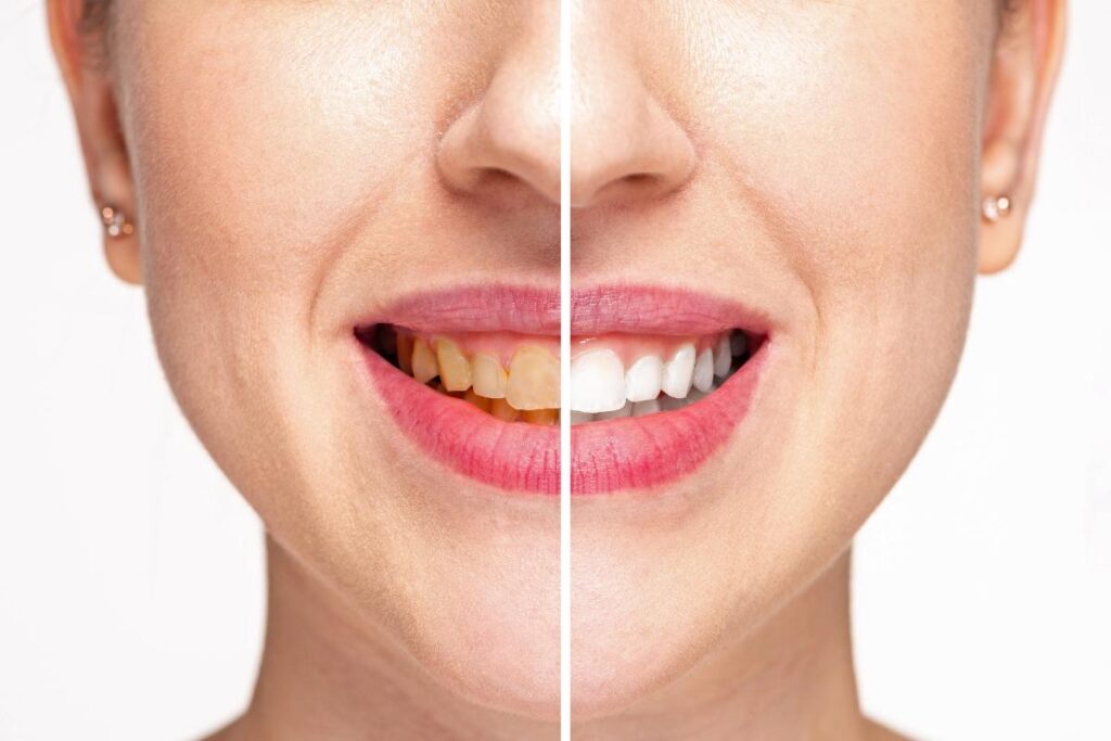 Prima e dopo dei denti macchiati di una donna