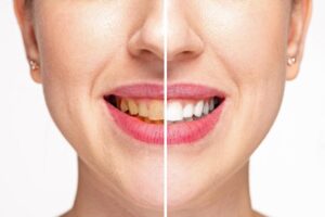 Prima e dopo dei denti macchiati di una donna