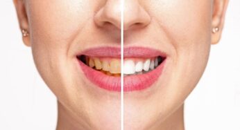 Macchie scure sui denti? Alcuni rimedi super efficaci per rimuoverle